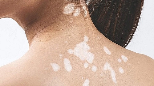 Da có đốm trắng là gì và cách điều trị hiệu quả Gallery 1