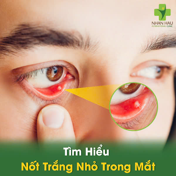 Lòng Trắng Mắt Có Đốm Trắng: Nguyên Nhân Và Cách Xử Lý Gallery 1