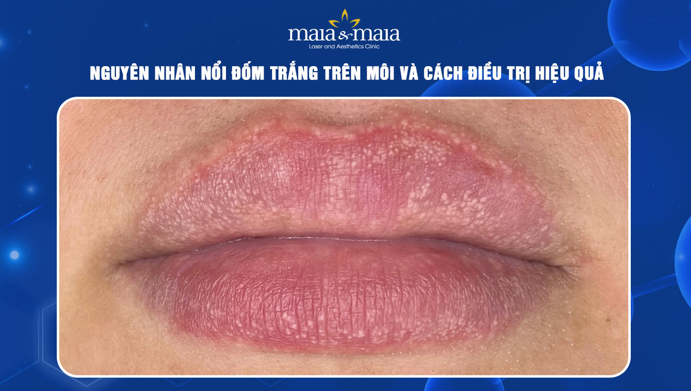 Trên môi có đốm trắng là bệnh gì? Gallery 1