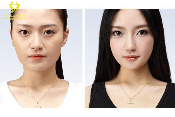 Gò Má Bên Cao Bên Thấp: Nguyên Nhân, Cách Khắc Phục và Điều Trị Gallery 1