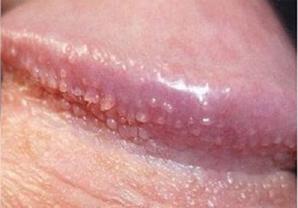 Dương vật nổi mụn li ti: Nguyên nhân và cách điều trị Gallery 1