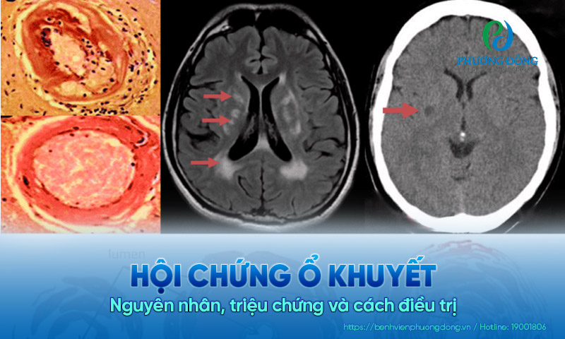 Hội chứng lỗ khuyết Gallery 1