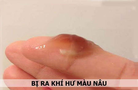 Huyết trắng có màu nâu nhạt: Nguyên nhân và cách xử lý Gallery 1