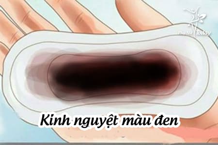 Kinh Nguyệt Màu Đen: Nguyên Nhân, Triệu Chứng và Cách Xử Lý Gallery 1