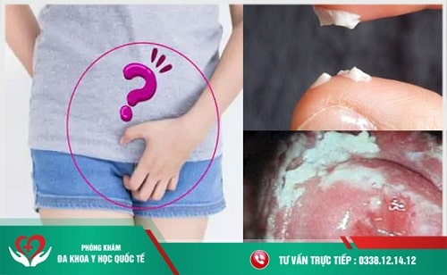 Bên trong vùng kín có mảng bám màu trắng Gallery 1