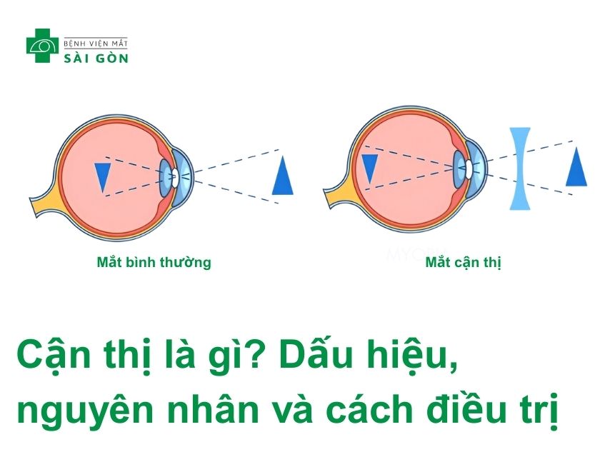 Mắt cận là gì? Gallery 1
