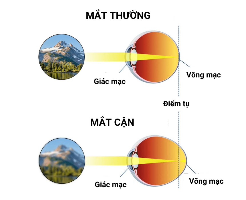 Thế nào là mắt cận? Gallery 1