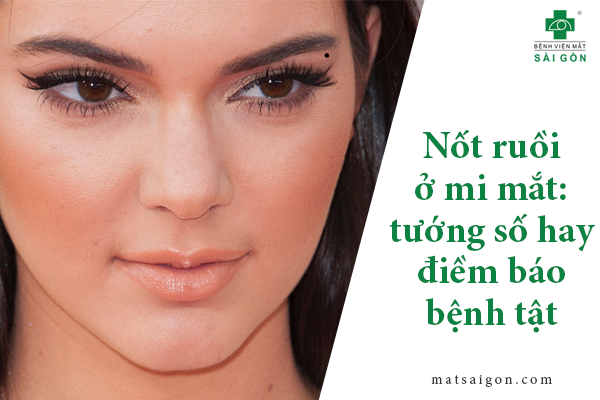 Mụn Ruồi Ở Mắt: Nguyên Nhân, Triệu Chứng Và Cách Xử Lý Gallery 1