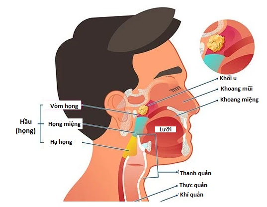 Nang Vòm Họng Có Nguy Hiểm Không? Gallery 2