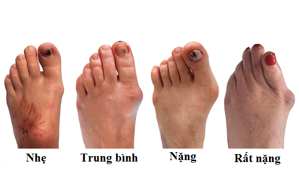Ngón Chân Cái To Tròn: Nguyên Nhân, Triệu Chứng Và Cách Khắc Phục Gallery 1