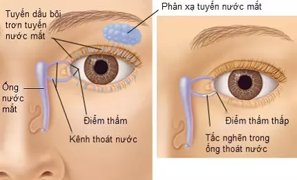 Nước mắt giàn giụa: Nguyên nhân, biểu hiện và cách khắc phục Gallery 1