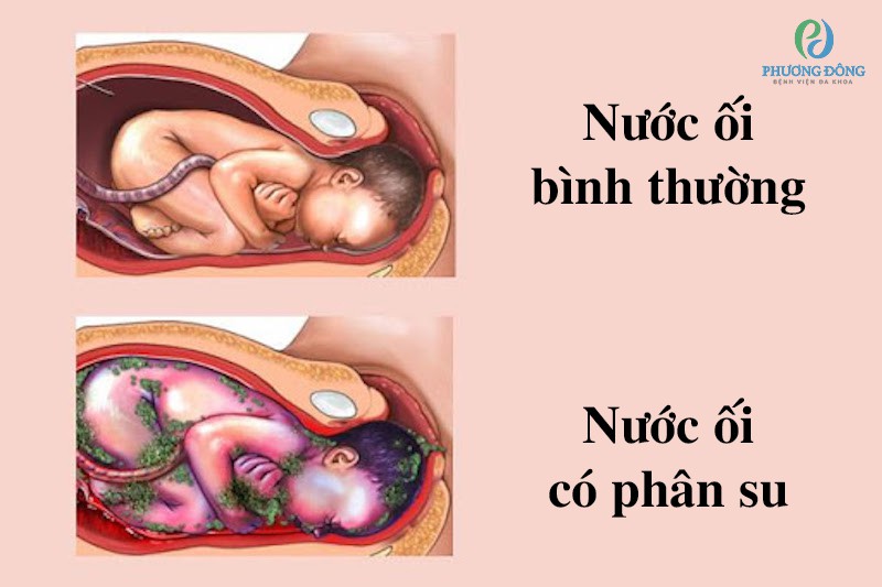 Phân Su Trong Nước ối Gallery 1