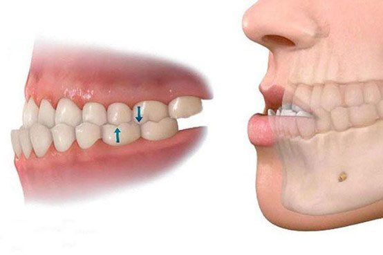Răng bị cụp vào trong: Nguyên nhân, triệu chứng và cách điều trị Gallery 1