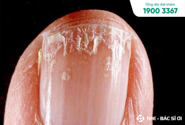 Móng Tay Bé Bị Tách Lớp: Nguyên Nhân, Cách Điều Trị Và Phòng Ngừa Gallery 1