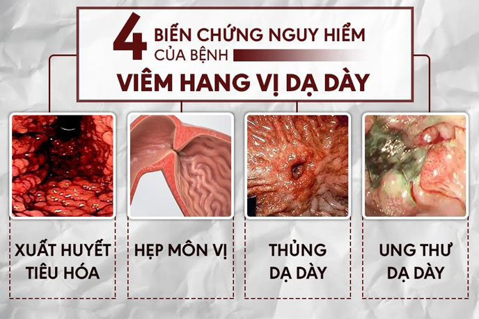 Viêm Xung Huyết Hang Vị Âm Tính Gallery 1