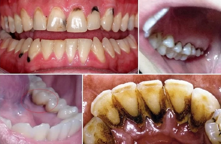 Vết Đen Giữa Kẽ Răng: Nguyên Nhân và Cách Khắc Phục Gallery 1