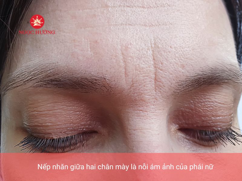 Vết Sẹo Giữa Hai Lông Mày: Nguyên Nhân, Điều Trị và Phòng Ngừa Gallery 1