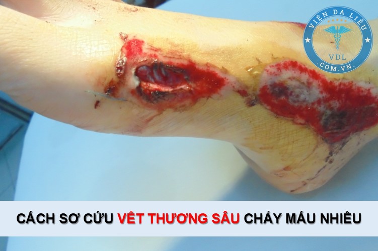 Vết Thương Sâu Hở Miệng: Nguyên Nhân, Cách Xử Trí Và Phòng Ngừa Gallery 1