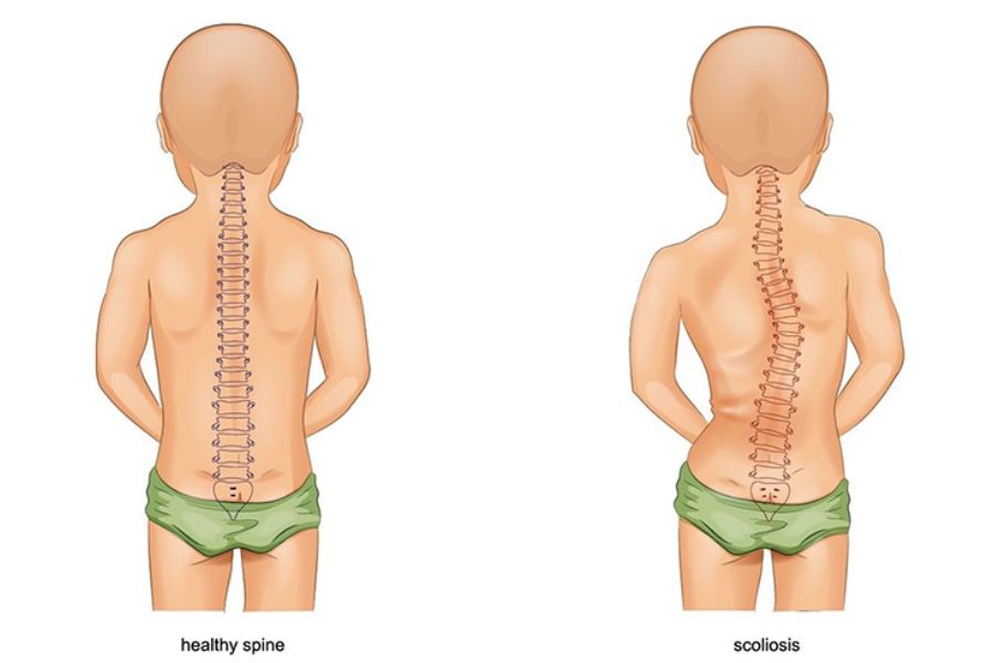 Vòng Eo Bị Lệch: Nguyên Nhân, Triệu Chứng và Cách Khắc Phục Gallery 1