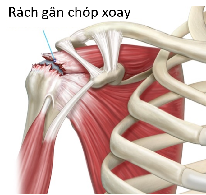 Rách Gân Cơ Trên Vai Gallery 1
