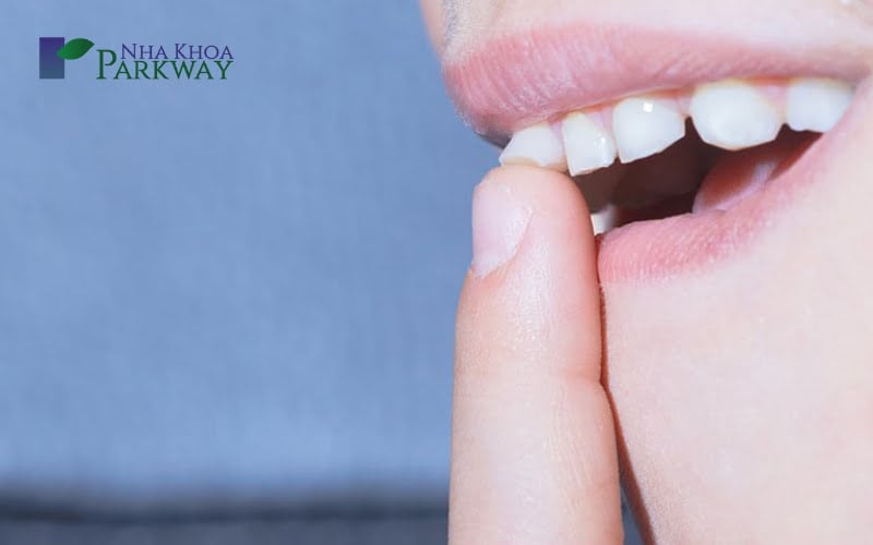 Răng cửa lung lay: Nguyên nhân, triệu chứng và cách xử lý Gallery 1