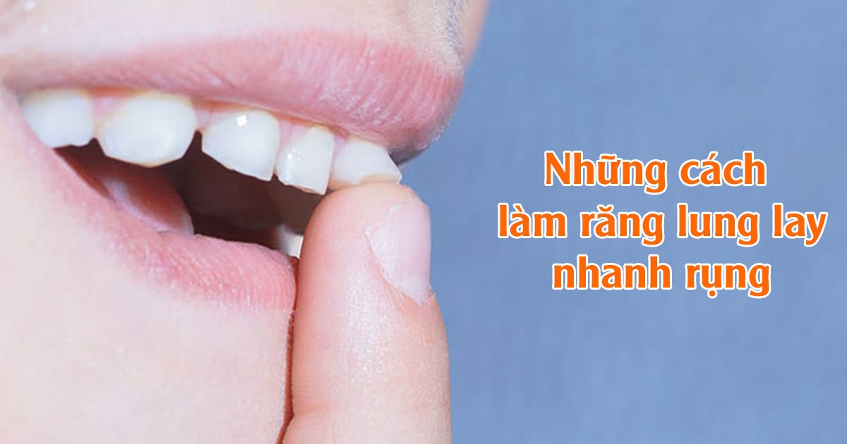 Cách Làm Răng Lung Lay Nhanh Rụng Gallery 1