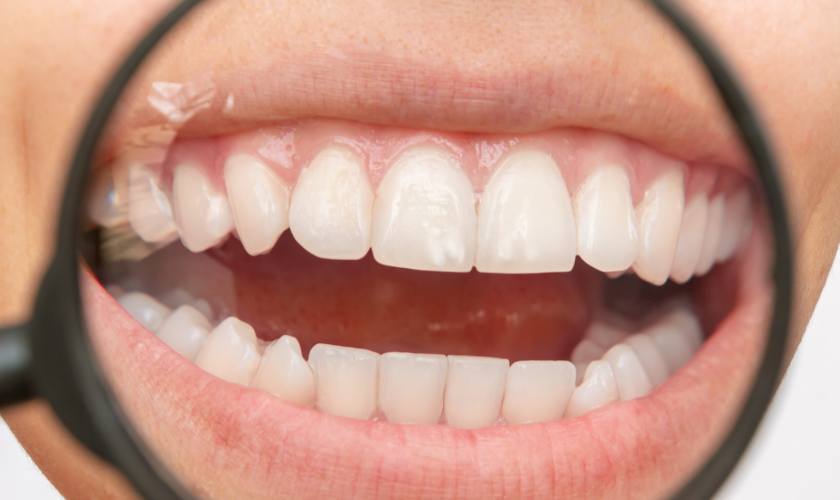 Răng Trẻ Bị Trắng Đục: Nguyên Nhân và Cách Xử Lý Gallery 1