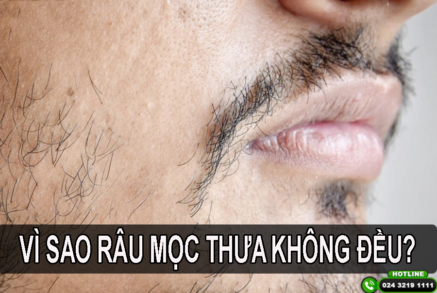 Râu Mọc Không Đều: Nguyên Nhân và Cách Khắc Phục Gallery 1