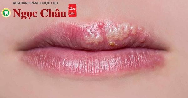 Thuốc Bôi Rộp Môi: Hướng Dẫn Chọn Và Sử Dụng Hiệu Quả Gallery 1