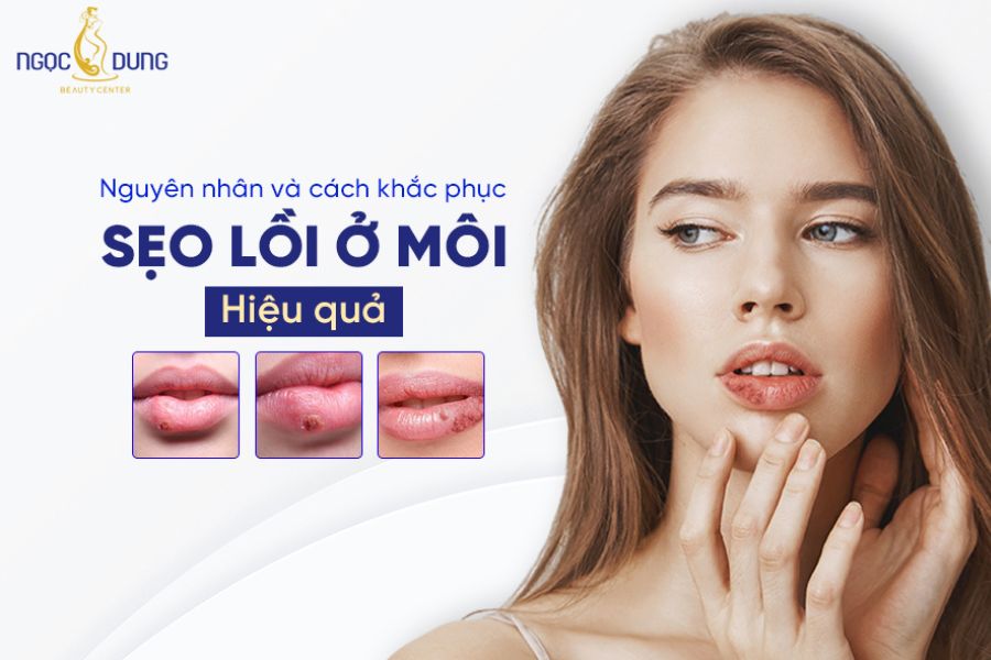 Sẹo Lồi Ở Môi: Nguyên Nhân, Điều Trị Và Phòng Ngừa Gallery 1