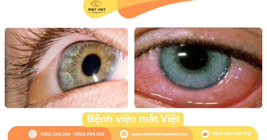 Sưng Tròng Trắng Mắt: Nguyên Nhân, Triệu Chứng và Cách Điều Trị Gallery 1