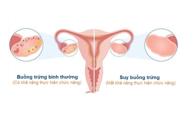 Suy Buồng Trứng Sớm Là Gì? Gallery 1