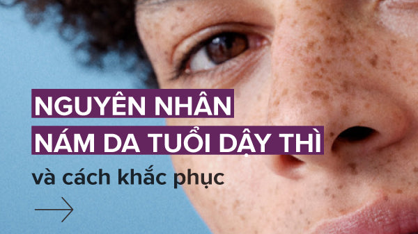 Cách Làm Hết Tàn Nhang Ở Tuổi Dậy Thì Gallery 1