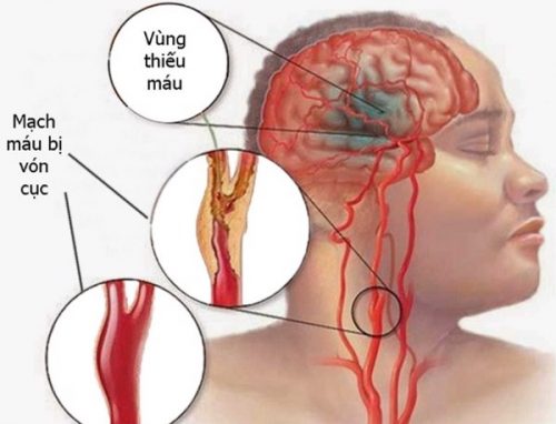 Tê Nửa Đầu Bên Trái Gallery 1