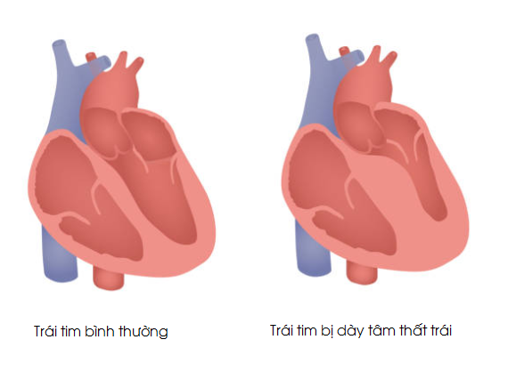 Thất Trái Tim Dày Có Chữa Khỏi Được Không? Gallery 1