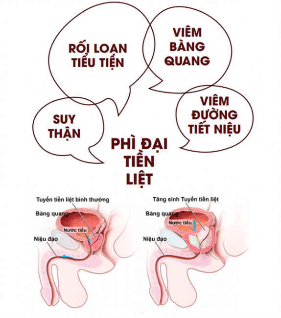 Tiểu Rắt Về Đêm: Nguyên Nhân, Cách Điều Trị Và Phòng Ngừa Gallery 1