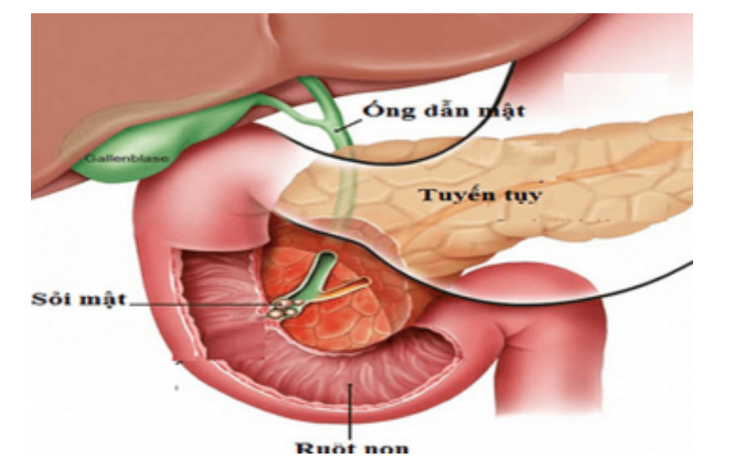 Tiều Tụy Là Gì? Gallery 1