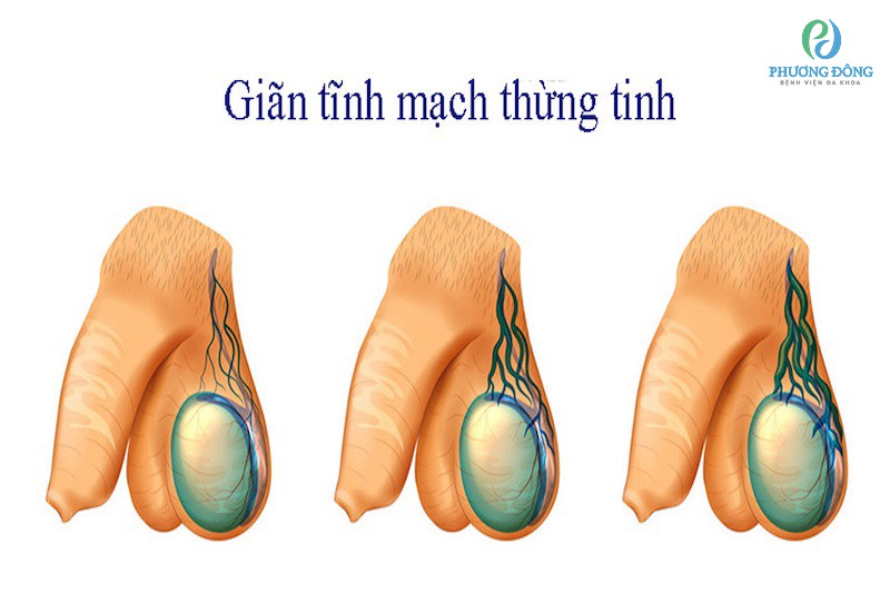 Tinh hoàn bị xệ: Nguyên nhân, triệu chứng và cách điều trị Gallery 1