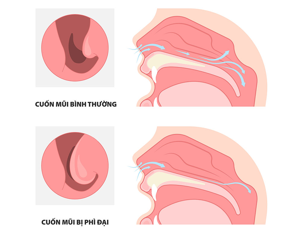 Trẻ Ngạt Mũi Khó Thở: Nguyên Nhân, Biện Pháp Khắc Phục & Phòng Ngừa Gallery 1