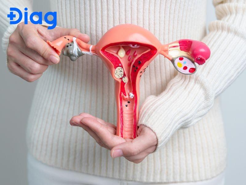 Treo Buồng Trứng Là Gì? Gallery 1