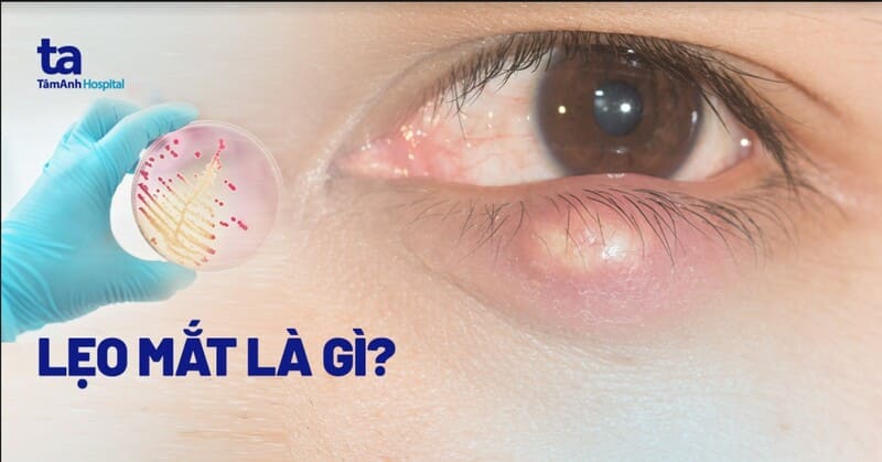 Trẹo Lẹo Là Gì? Nguyên Nhân, Cách Điều Trị Và Phòng Ngừa Gallery 1