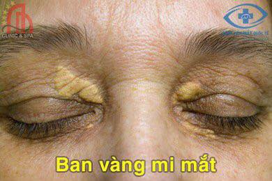 Cách Trị U Mỡ Vàng Xung Quanh Mắt Gallery 1