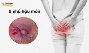 U nhú hậu môn Gallery 1