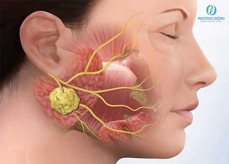 Ù Tai Phải: Nguyên Nhân, Triệu Chứng và Điều Trị Gallery 1