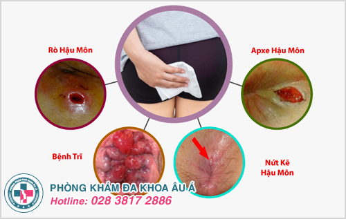 Hiện tượng ướt hậu môn: Nguyên nhân và cách xử lý Gallery 1