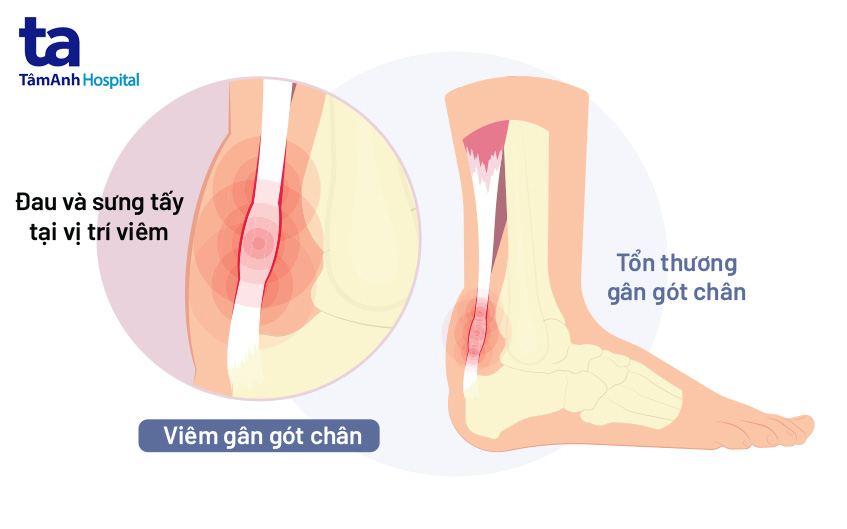 Gân Duỗi Bàn Chân: Nguyên Nhân, Triệu Chứng Và Cách Điều Trị Gallery 1