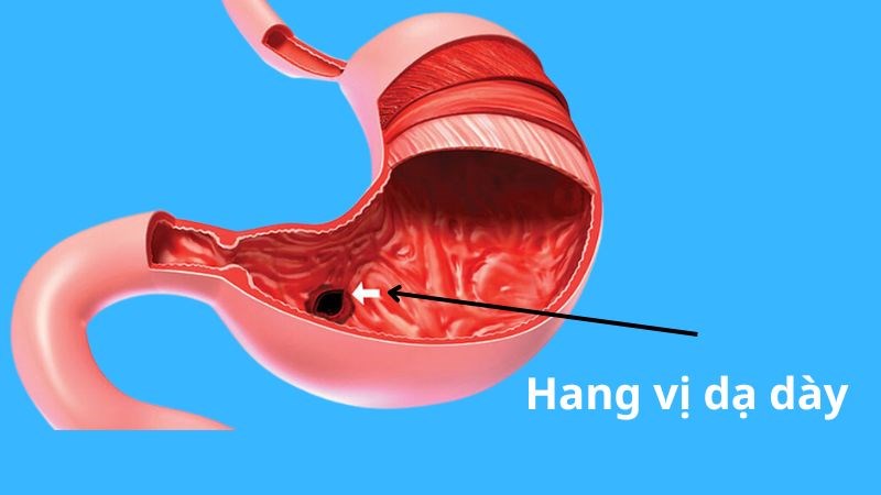 Viêm Niêm Mạc Hang Vị: Nguyên Nhân, Triệu Chứng & Điều Trị Gallery 1