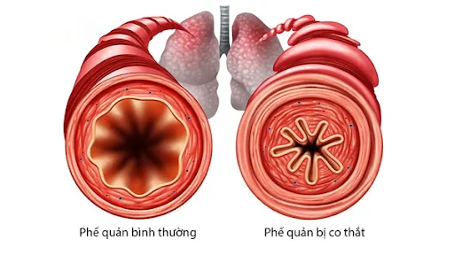 Viêm Phế Quản Co Thắt Gallery 2