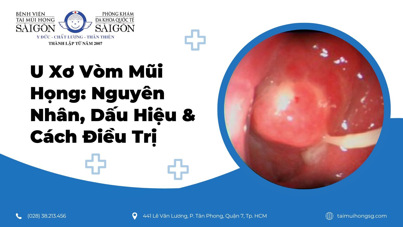 Viêm Vòm Mũi Họng: Nguyên Nhân, Triệu Chứng và Cách Điều Trị Gallery 1