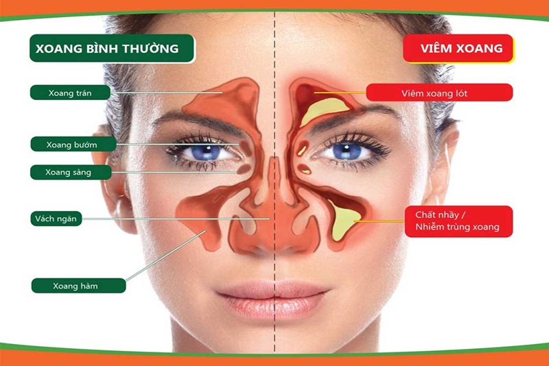 Viêm Xoang Có Lây Không? Gallery 1